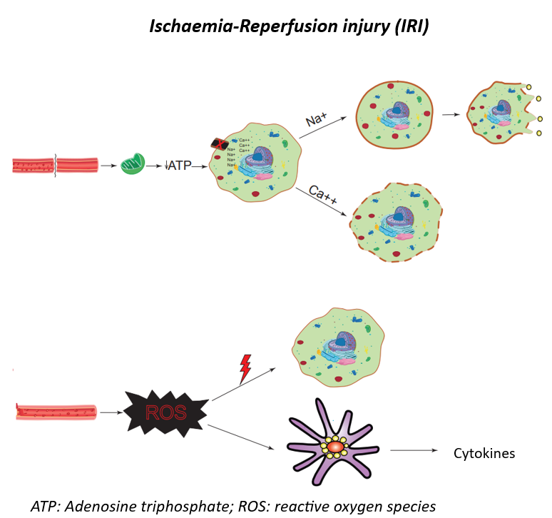 Diagram illustrating Ischaemia-Reperfusion Injury (IRI)